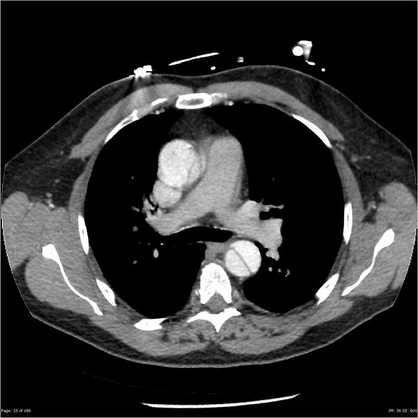 File:Aortic dissection- Stanford A (Radiopaedia 37759-39664 A 26).jpg