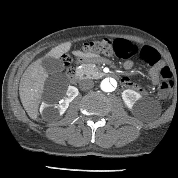 File:Aortic dissection - DeBakey Type I-Stanford A (Radiopaedia 79863-93115 A 51).jpg