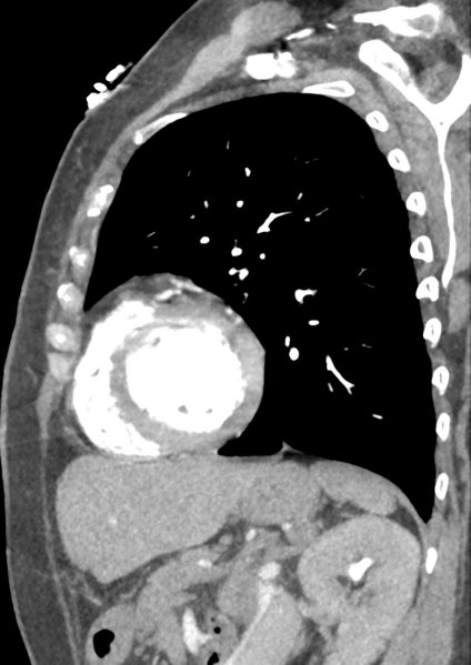 File:Aortic dissection - Stanford type B (Radiopaedia 50171-55512 C 11).png