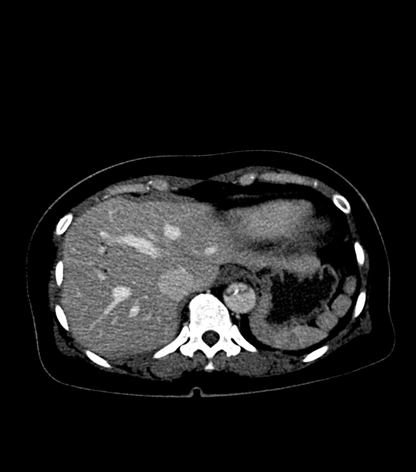 Aortic dissection with renal ischemia (Radiopaedia 76573-88338 B 22).jpg