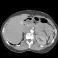 Aortic valve non-coronary cusp thrombus (Radiopaedia 55661-62189 B 54).png