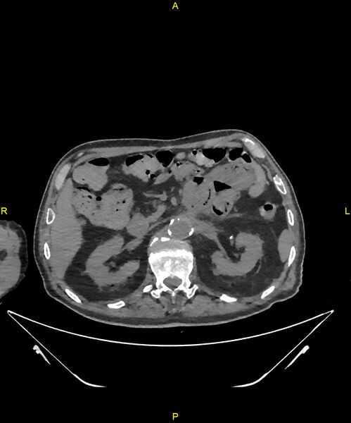 File:Aortoenteric fistula (Radiopaedia 84308-99603 Axial non-contrast 109).jpg