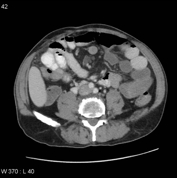 File:Appendicitis (Radiopaedia 27446-27642 A 21).jpg
