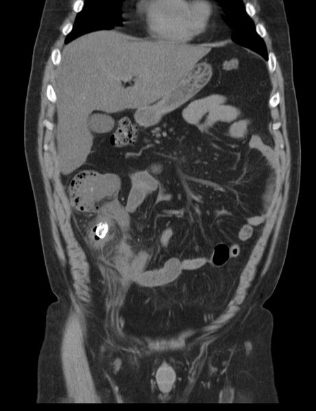 File:Appendicitis and giant appendicolith (Radiopaedia 80251-93588 Coronal non-contrast 14).jpg