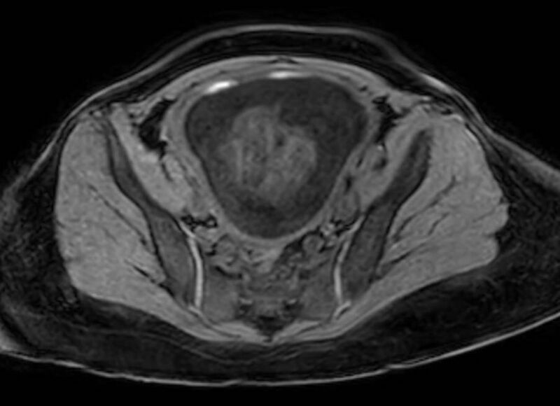 File:Appendicitis in gravida (MRI) (Radiopaedia 89433-106395 Axial DIXON 119).jpg