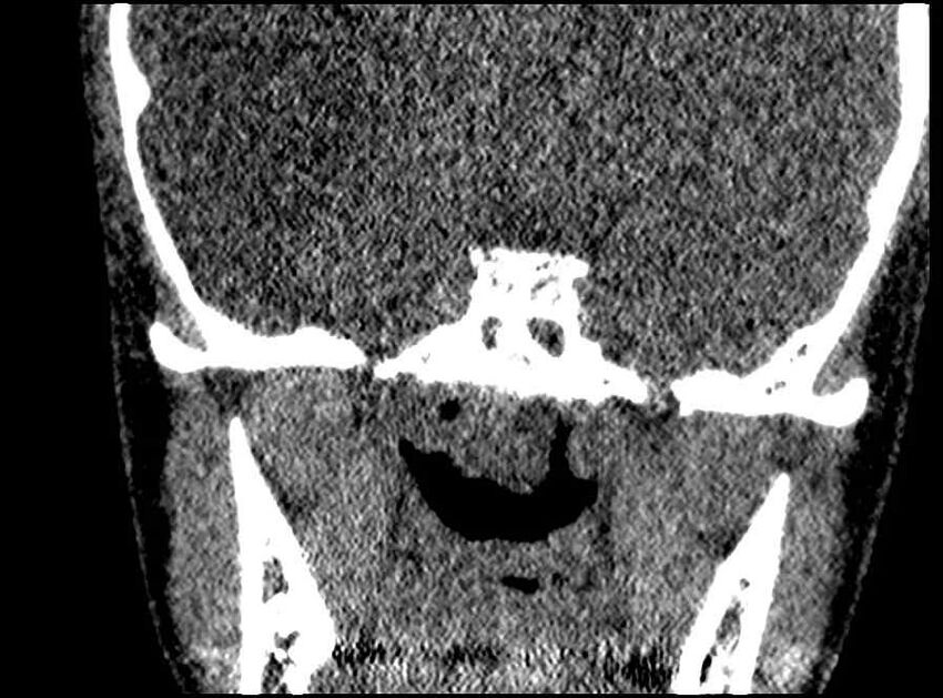 Arachnoid cyst- extremely large (Radiopaedia 68741-78450 Coronal bone window 9).jpg