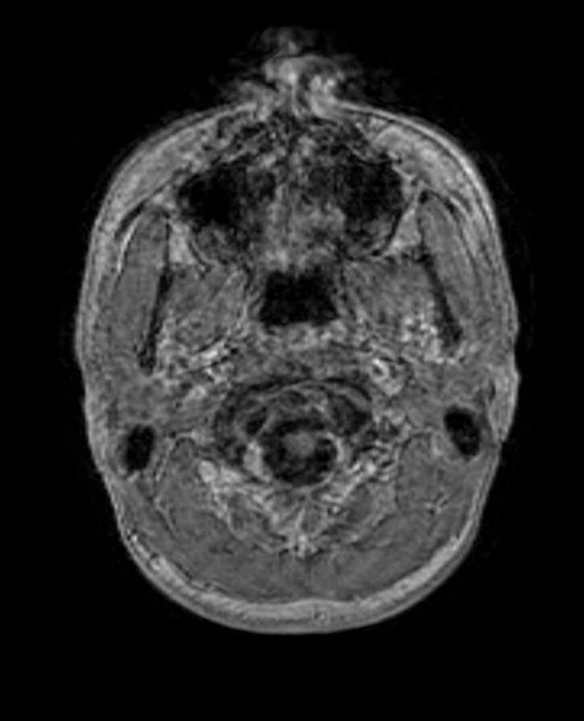Arachnoid cyst- extremely large (Radiopaedia 68741-78451 Axial T1 C+ 7).jpg