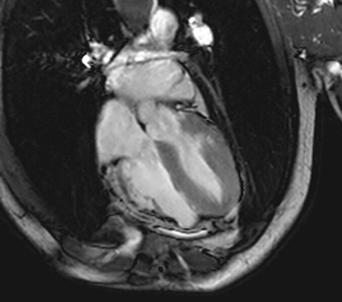 File:Arrhythmogenic right ventricular cardiomyopathy (Radiopaedia 39806-42237 D 14).jpg