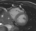 Arrhythmogenic right ventricular cardiomyopathy (Radiopaedia 39806-42237 F 16).jpg
