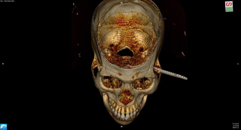 File:Arrow injury to the head (Radiopaedia 75266-86388 3D vertical 13).jpg