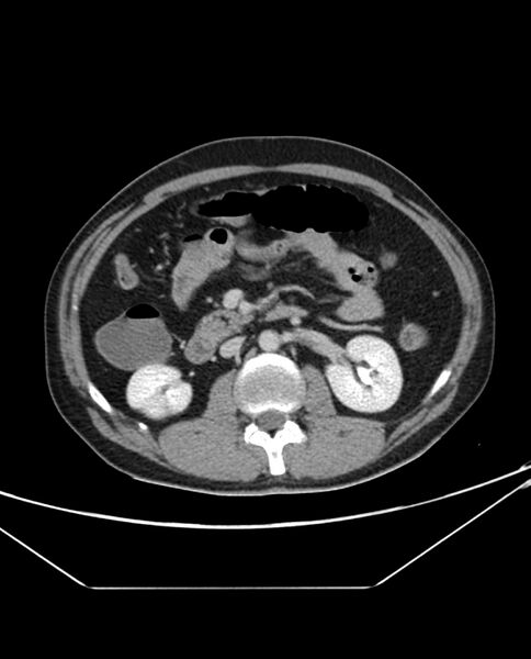File:Arterial occlusive mesenteric ischemia (Radiopaedia 84641-100054 A 50).jpg
