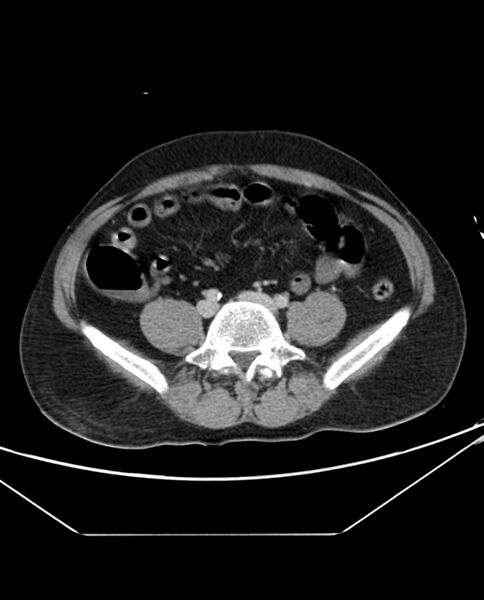 File:Arterial occlusive mesenteric ischemia (Radiopaedia 84641-100054 A 81).jpg
