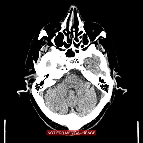 File:Artery of Percheron infarction (Radiopaedia 28679-28967 Axial non-contrast 29).jpg