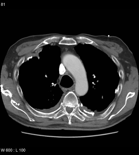 File:Asbestos related lung and pleural disease (Radiopaedia 14377-14301 D 17).jpg