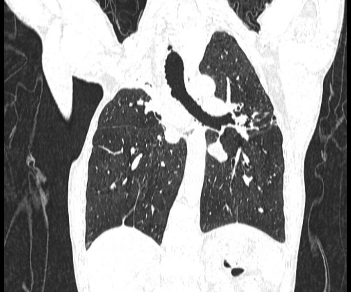 File:Aspergillomas (Radiopaedia 66779-76110 Coronal lung window 12).jpg