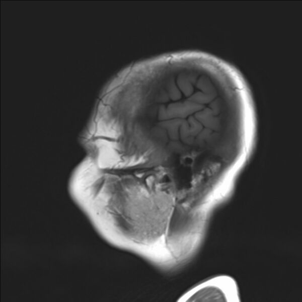 File:Atlanto-occipital assimilation with basilar invagination (Radiopaedia 70122-80157 Sagittal T1 1).jpg