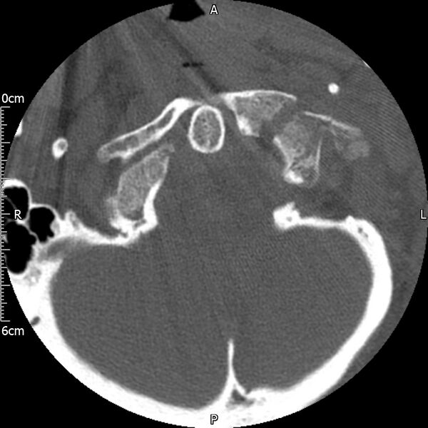 File:Atlas fracture with Currarino type A congenital defect (Radiopaedia 71747-82144 Axial bone window 27).jpg