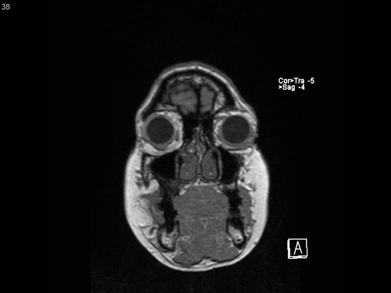 File:Atypical meningioma - intraosseous (Radiopaedia 64915-74572 Coronal T1 38).jpg