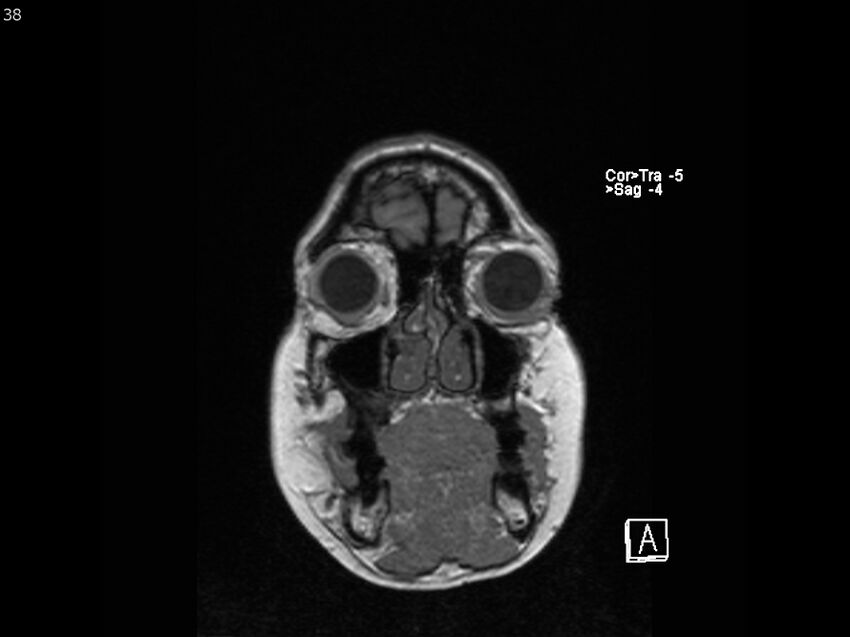 Atypical meningioma - intraosseous (Radiopaedia 64915-74572 Coronal T1 38).jpg