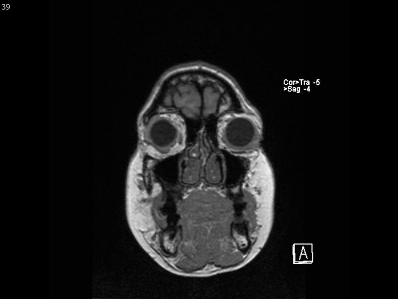 File:Atypical meningioma - intraosseous (Radiopaedia 64915-74572 Coronal T1 39).jpg