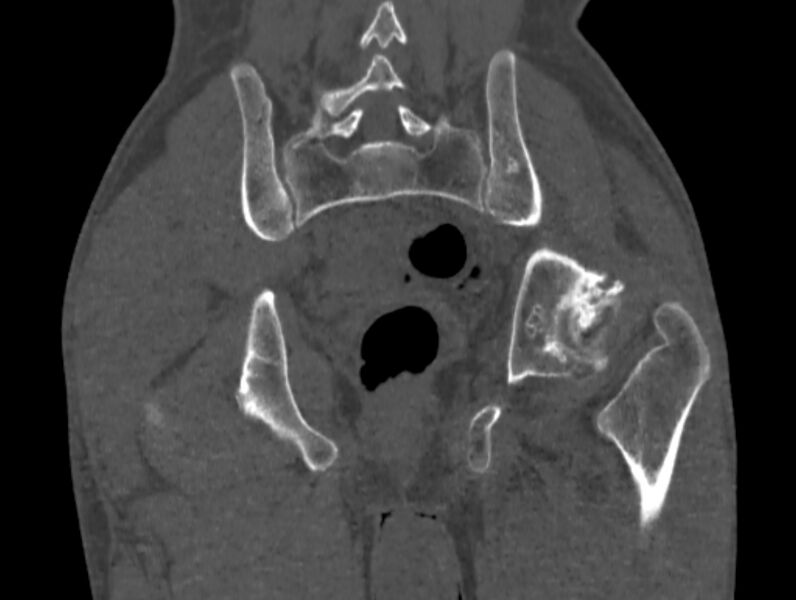 File:Avascular necrosis of the left hip (Radiopaedia 75068-86125 Coronal bone window 70).jpg
