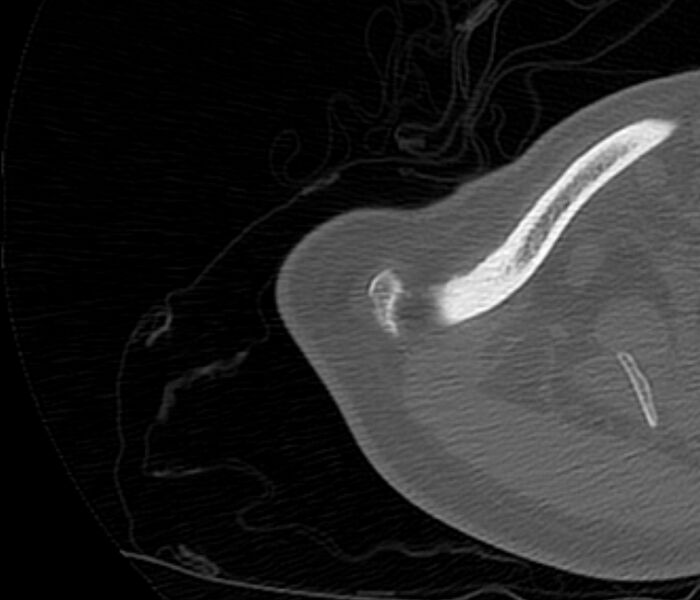 File:Avulsion fracture - greater tuberosity of humerus (Radiopaedia 71216-81514 Axial bone window 3).jpg