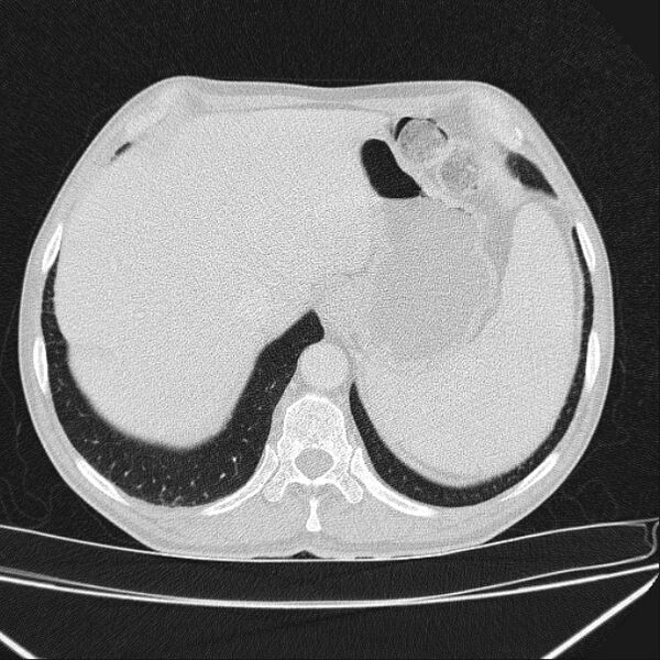 File:Azygos lobe (Radiopaedia 38259-40275 Axial lung window 73).jpg