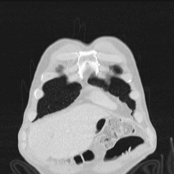 File:Azygos lobe (Radiopaedia 38259-40275 Coronal lung window 11).jpg
