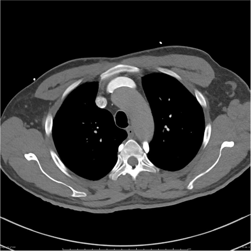 Azygos venous system anatomy (CT pulmonary angiography) (Radiopaedia 25928-26077 Axial C+ CTPA 21).jpg