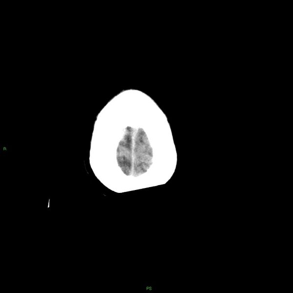 File:Basal ganglia hemorrhage (Radiopaedia 58349-65472 Axial non-contrast 8).jpg