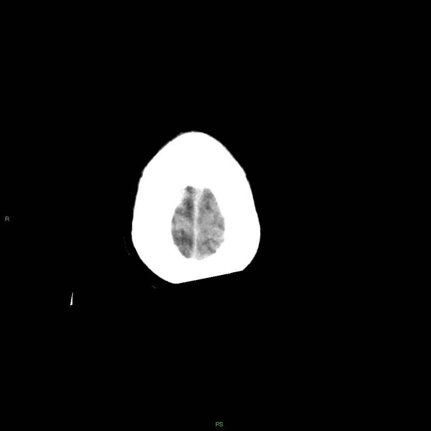 Basal ganglia hemorrhage (Radiopaedia 58349-65472 Axial non-contrast 8).jpg