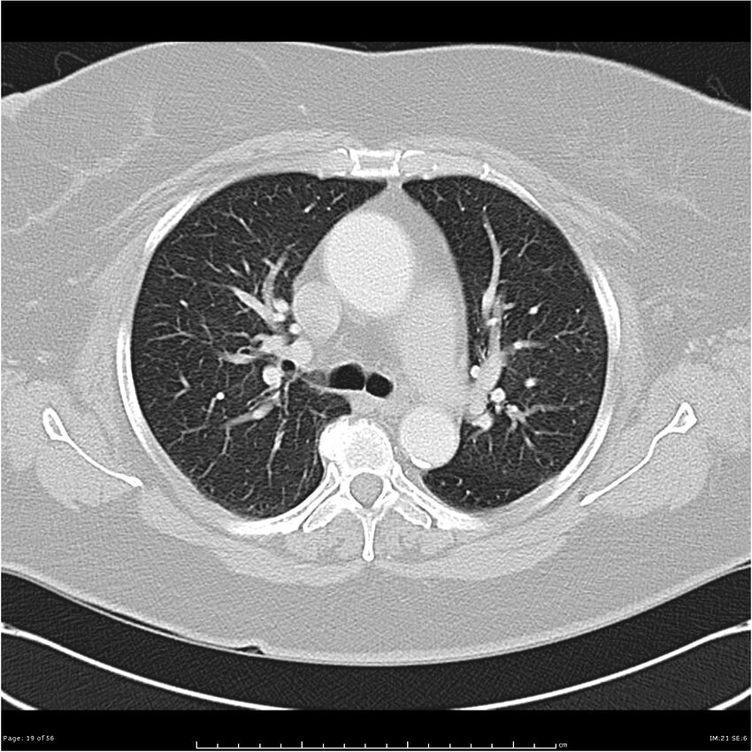 Benign metastasizing leiomyoma (Radiopaedia 26803-26962 Axial lung window 19).jpg