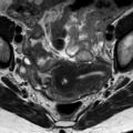 Bicornuate uterus (Radiopaedia 61974-70046 Axial T2 4).jpg