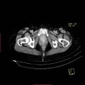 Bifid ureter (Radiopaedia 47604-52253 Axial C+ delayed 31).jpg