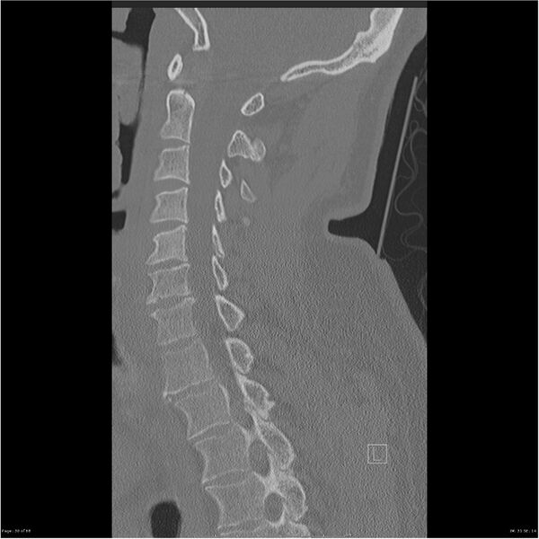 File:Bilateral cervical ribs (Radiopaedia 25868-26017 Sagittal bone window 30).jpg