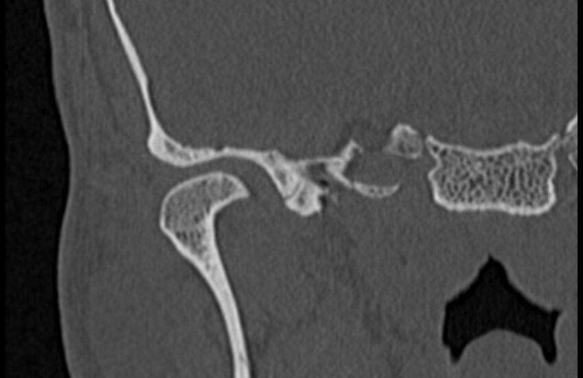Bilateral cholesteatoma (Radiopaedia 54898-61172 Coronal bone window 4).jpg