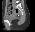 Bilateral mature cystic ovarian teratoma (Radiopaedia 88821-105592 D 18).jpg
