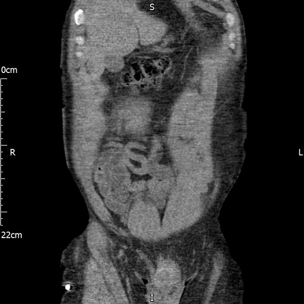 File:Bilateral medullary nephrocalcinosis with ureteric calculi (Radiopaedia 71269-81569 Coronal non-contrast 13).jpg