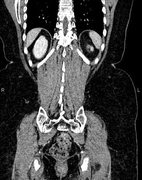 File:Bilateral ovarian serous cystadenocarcinoma (Radiopaedia 86062-101989 D 45).jpg
