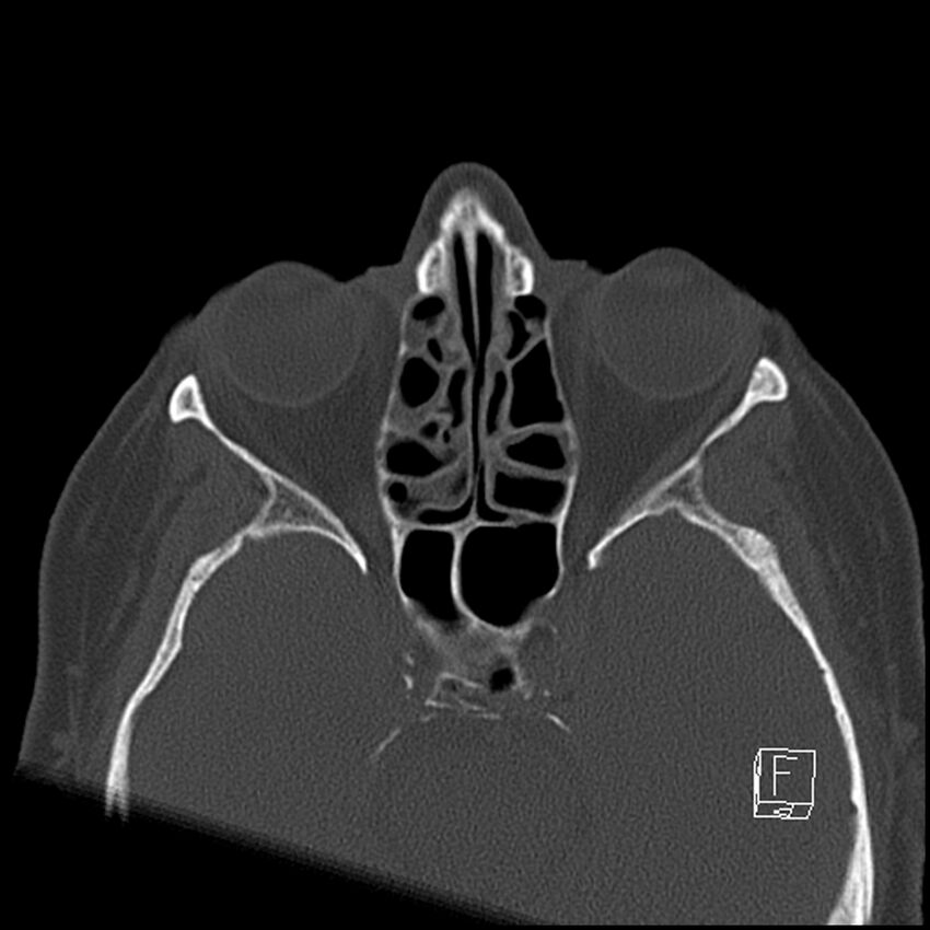 Bilateral palatine tonsilloliths on OPG and CT (Radiopaedia 75167-86247 Axial bone window 9).jpg