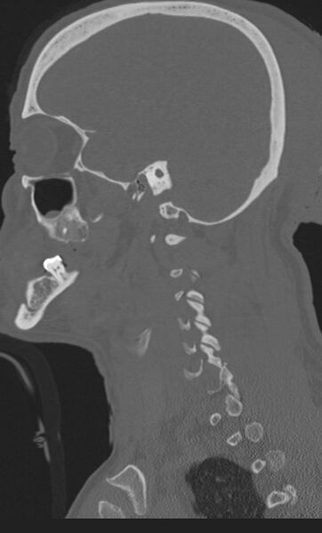 File:Bilateral perched facet joint (Radiopaedia 63149-71669 Sagittal bone window 63).jpg