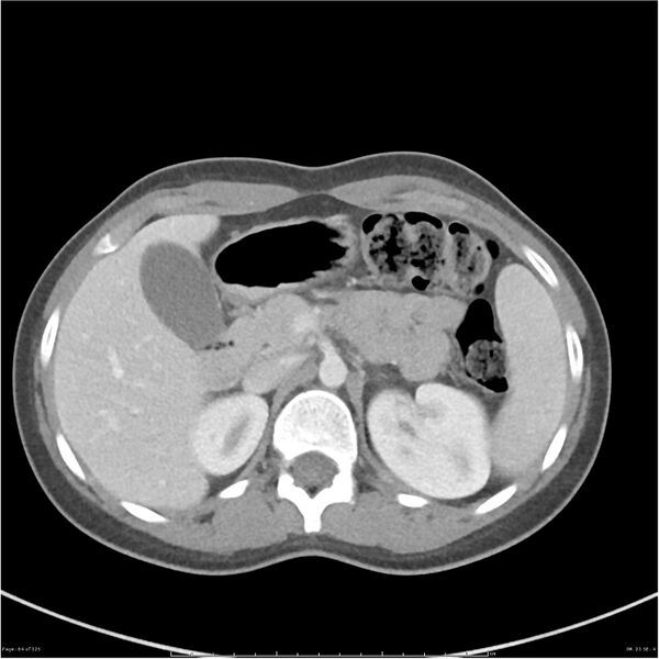 File:Bilateral ureteritis and cystitis (Radiopaedia 25340-25594 A 21).jpg