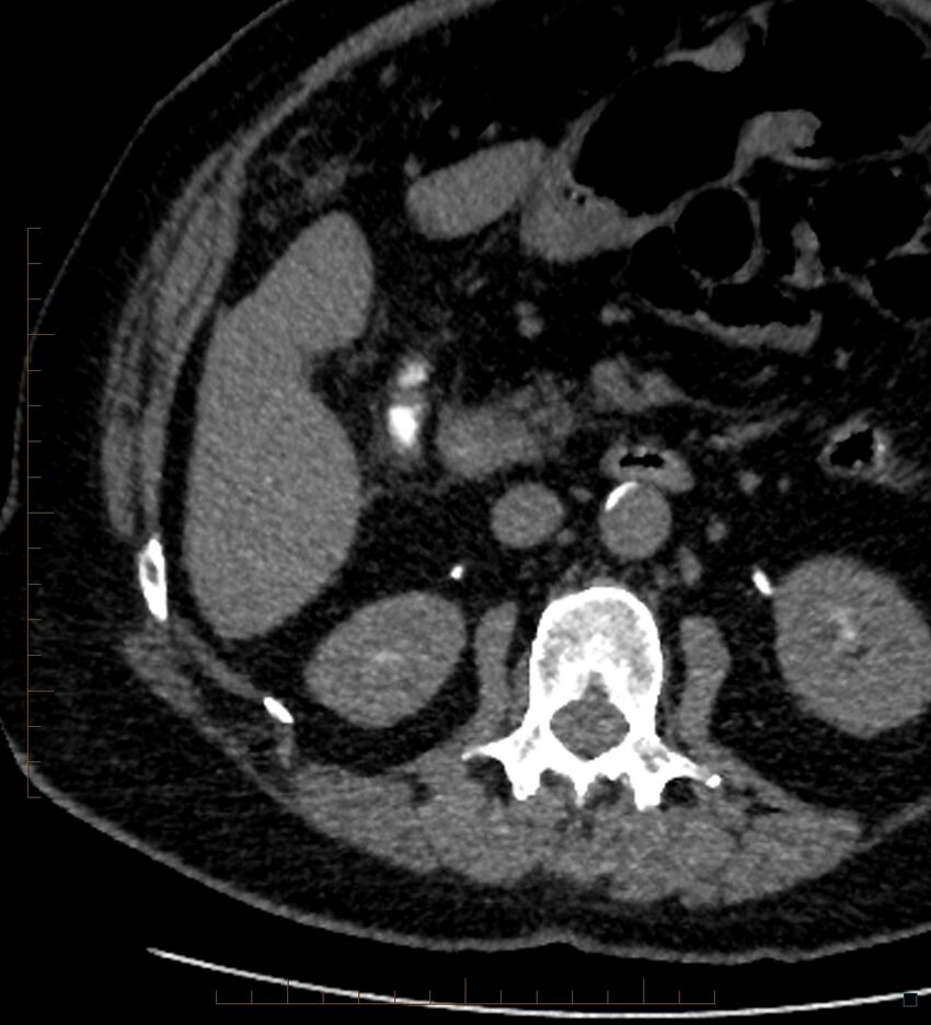Bile leak from accessory duct(s) of Luschka post cholecystectomy (Radiopaedia 40736-43389 A 47).jpg