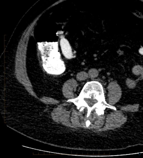 File:Bile leak from accessory duct(s) of Luschka post cholecystectomy (Radiopaedia 40736-43389 A 69).jpg