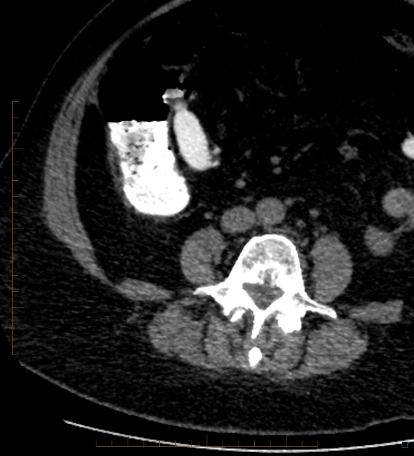Bile leak from accessory duct(s) of Luschka post cholecystectomy (Radiopaedia 40736-43389 A 69).jpg