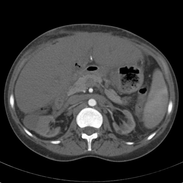 File:Biliary necrosis - liver transplant (Radiopaedia 21876-21846 A 28).jpg