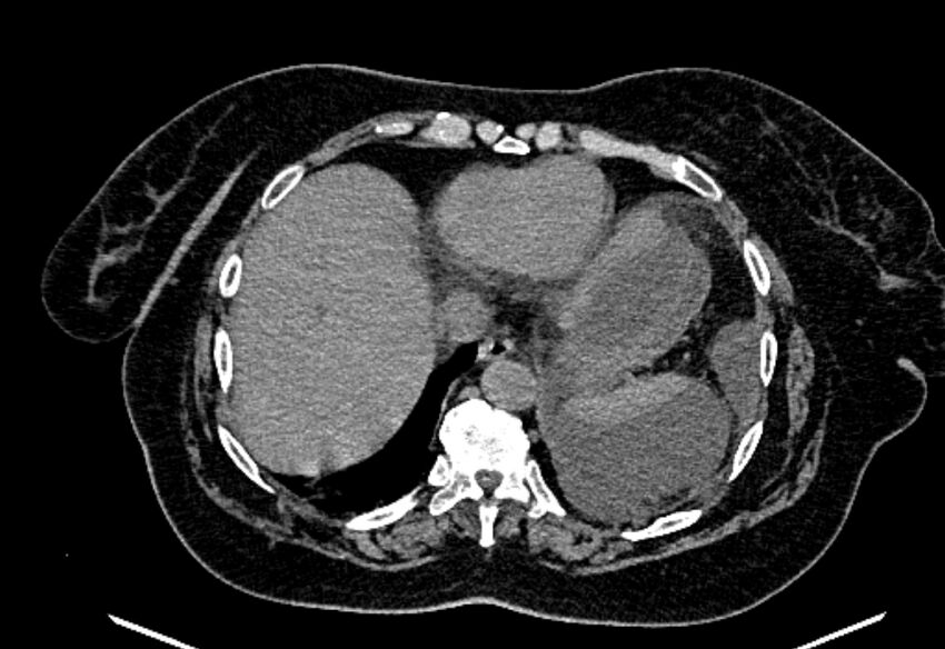 Biliary pancreatitis (Radiopaedia 72289-82823 Axial non-contrast 40).jpg