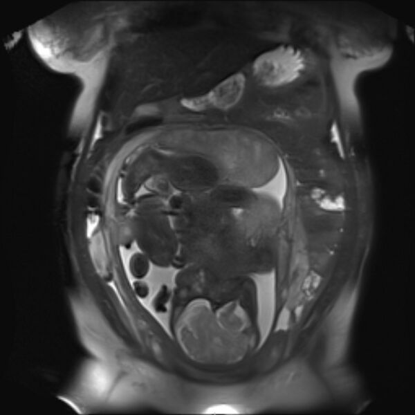 File:Bilobed placenta accreta (Radiopaedia 69648-79591 Coronal T2 fat sat 15).jpg