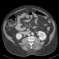 Bladder papillary urothelial carcinoma (Radiopaedia 48119-52951 Axial 27).png