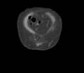 Bladder papillary urothelial carcinoma (Radiopaedia 48119-52951 C 4).png